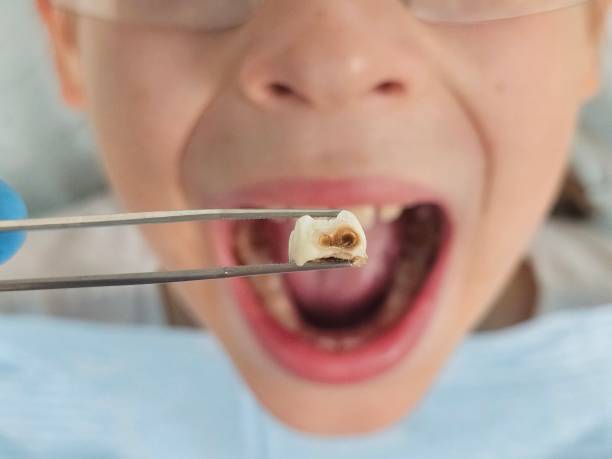 Best Emergency Dental Care for Sports Injuries in Listoga, CA